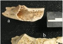 Bone Tumor in 120,000-Year-Old Neandertal Discovered