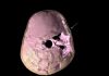 3-D image of Paleolithic child’s skull reveals trauma, brain damage