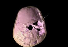3-D image of Paleolithic child’s skull reveals trauma, brain damage