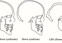 New research counters claim that the ‘Hobbit’ had Down syndrome