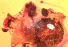 For 100 million years, amber freezes a tableau of tick’s worst day ever This silk-wrapped tick subsequently was entombed in amber that may have dripped from a nearby tree.